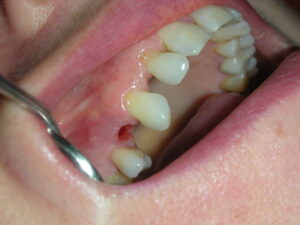 implante dental en pias clinica dental