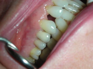 implante dental en santiago de compostela