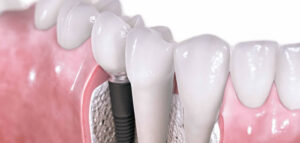 implantes dentales-pias clinica dental