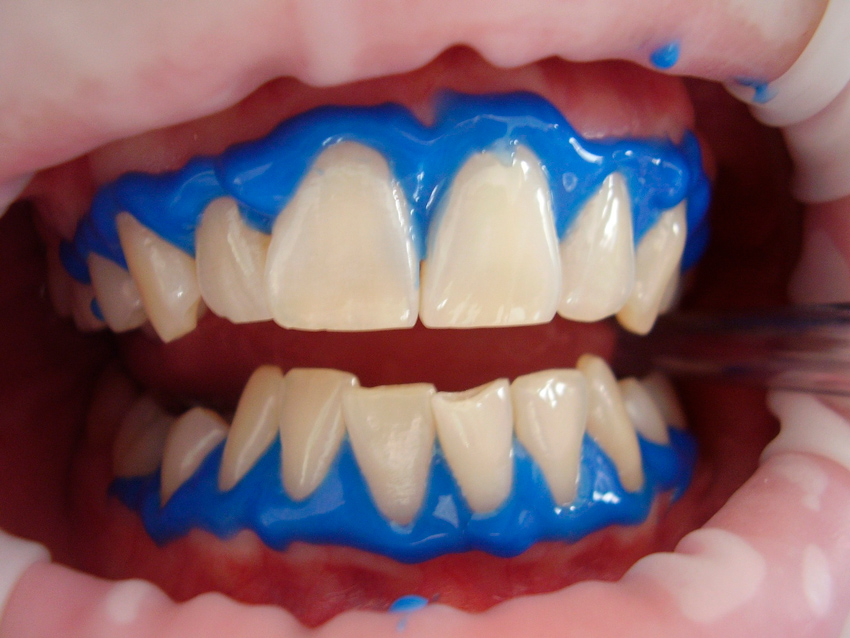 El gen blanqueador se usa durante un blanqueamiento dental para proteger los tejidos blandos de la boca