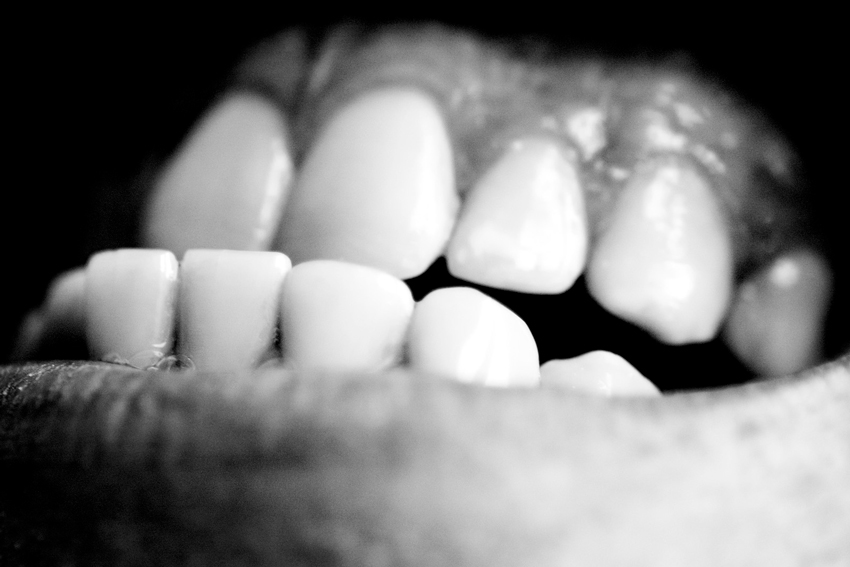 El bruxismo se caracteriza por el movimiento inconsciente de los dientes, de lado a lado
