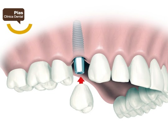 implantes dentales en santiago de compostela