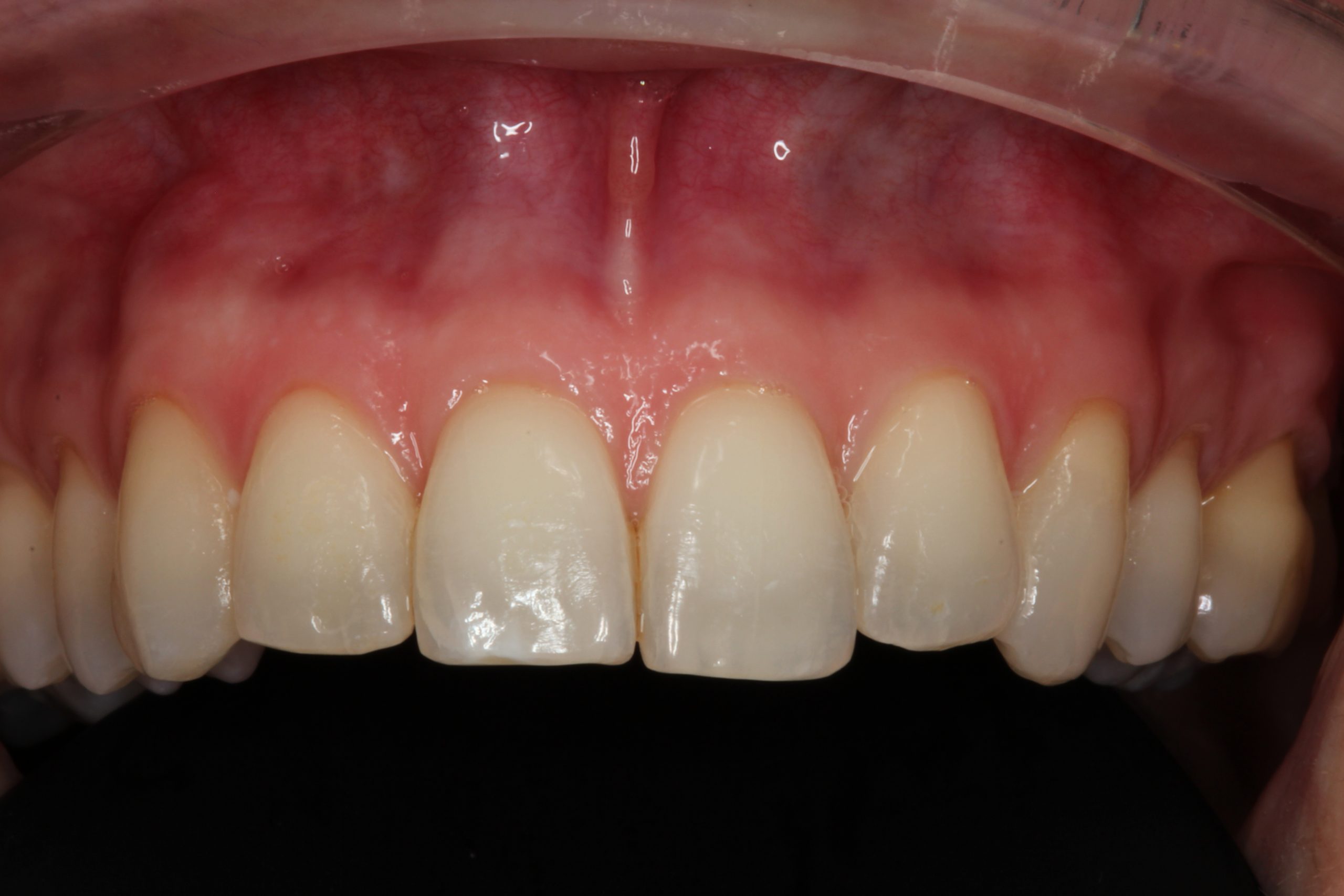 Precio implante dental-pias clinica dental