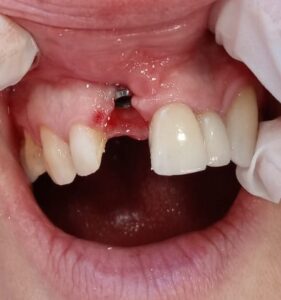 retraccion de encias en implantes dentales- pias clinica dental
