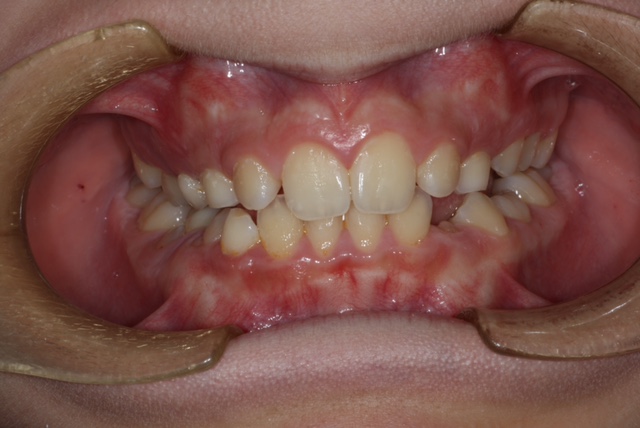 piasclincadental-ortodoncia interceptiva