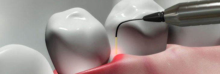 LASER DENTAL. pias clinica dental